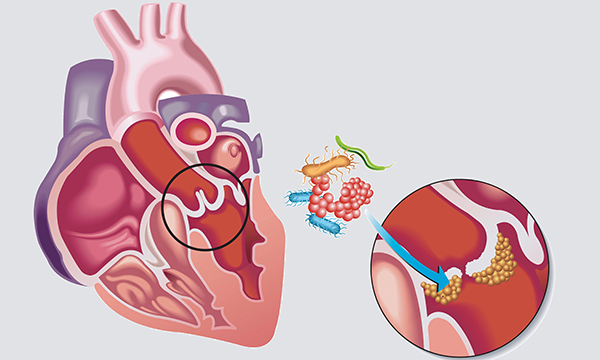 Bacterial endocarditis: an overview of the pathophysiology, symptoms and treatment