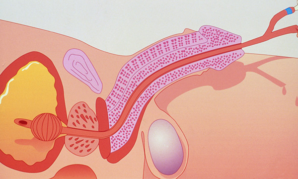 Urinary catheterisation