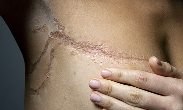 Breast cancer surgery scar