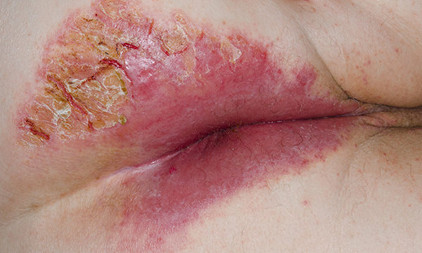 Dermatitis around the anus