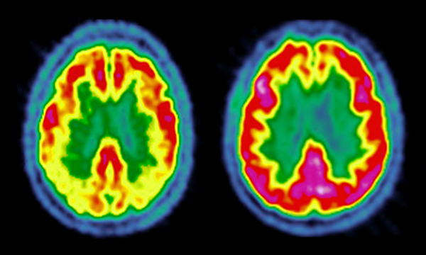 Brain_activity_in_Lewy_body_dementia