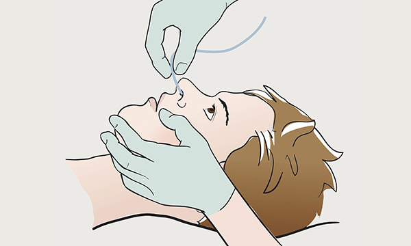 Nasogastric intubation