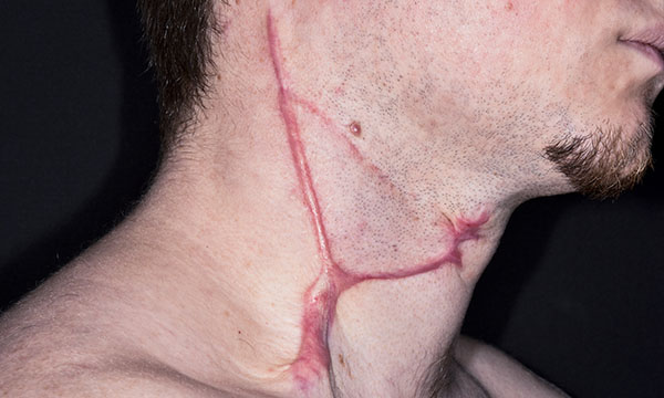 Head and neck cancer