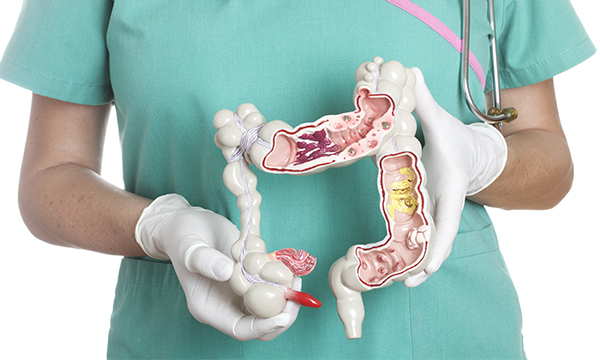 Bowel cancer screening