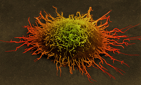 Cervical_cancer_cell-SPL.jpg