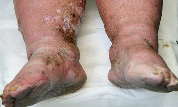 Chronic oedema