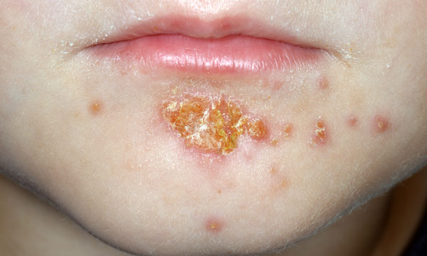 Crust impetigo