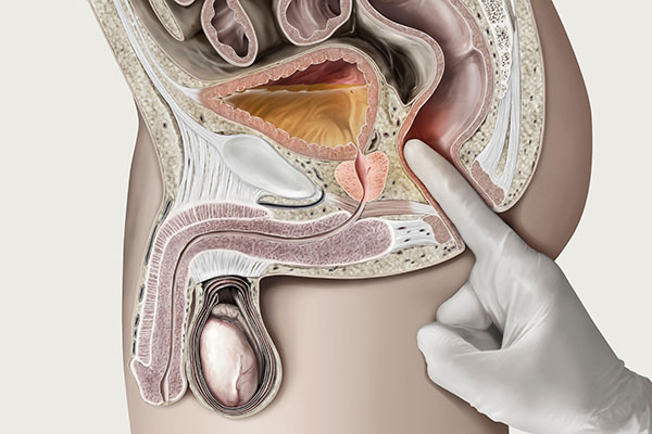Digital rectal examination