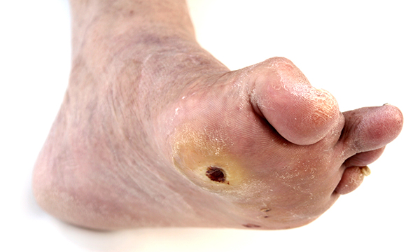 Diabetic_foot_ulcer