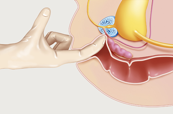 Digital rectal examination