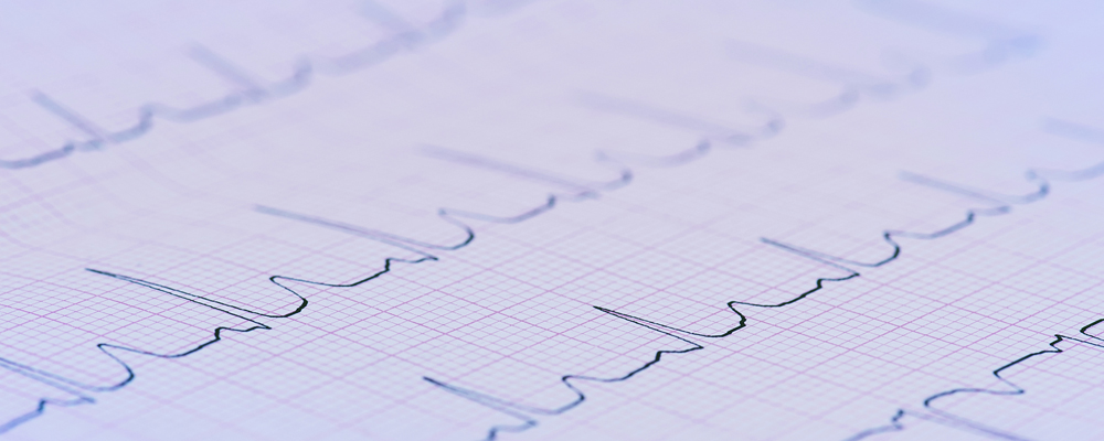 Electrocardiogram