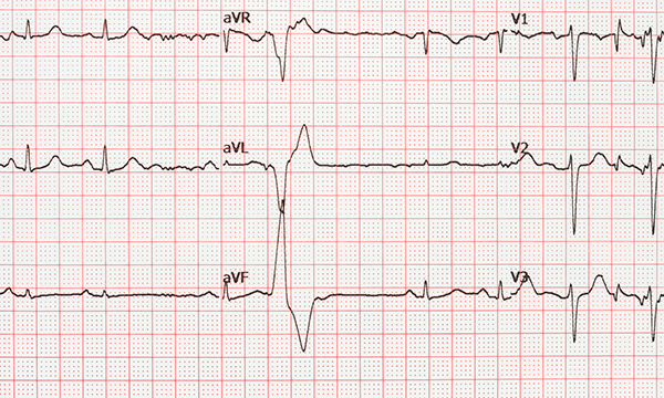 ECG