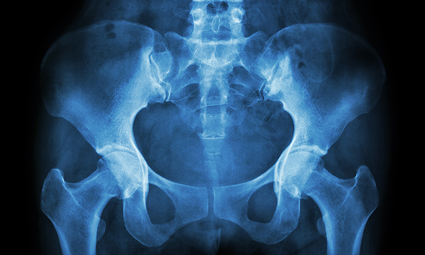 Pelvic exenteration for rectal cancers