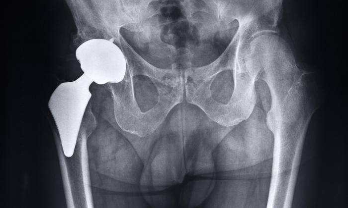 hip replacement