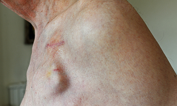 Implantable cardioverter defibrillator