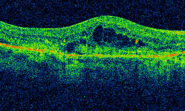 Intravitreal injections