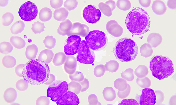 Leukaemia