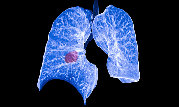 Lung Cancer