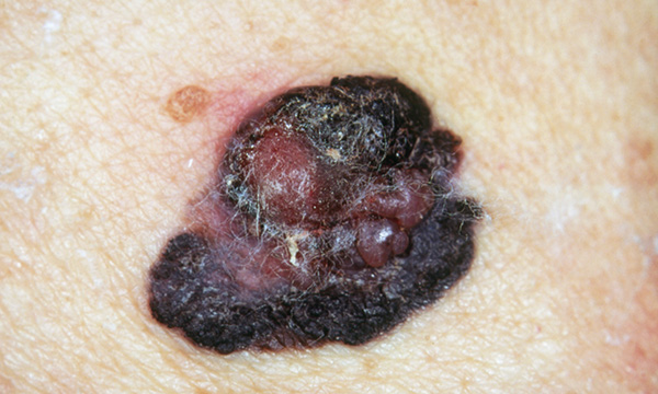 Malignant melanoma