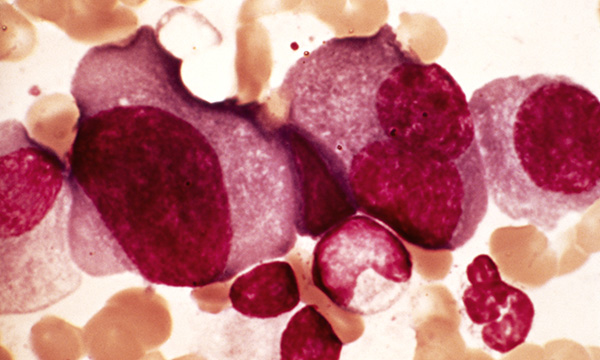 Myeloma