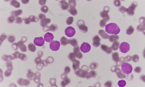 Myelodysplastic syndromes