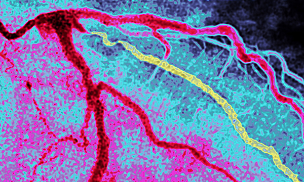Myocardial Infarction