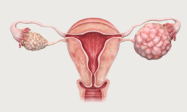 Ovarian cancer