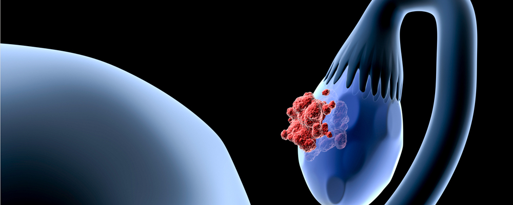 Ovarian Cancer