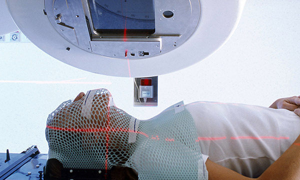 radiotherapy 