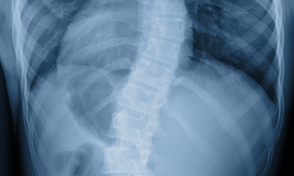 Scoliosis