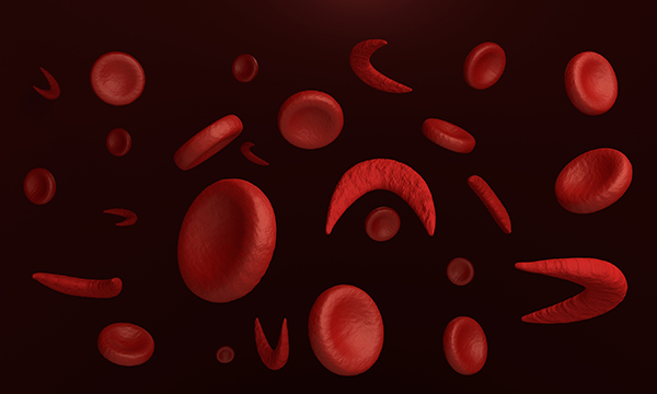 Sickle cell disease