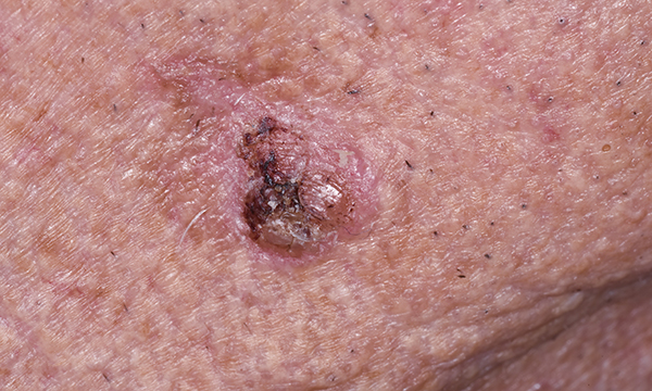 Squamous cell carcinoma