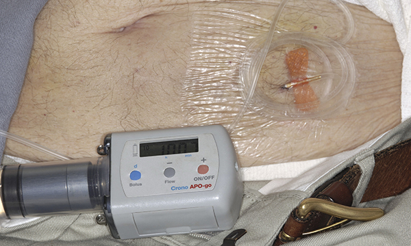 Treating Parkinson's