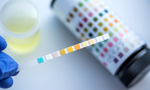 Urine analysis