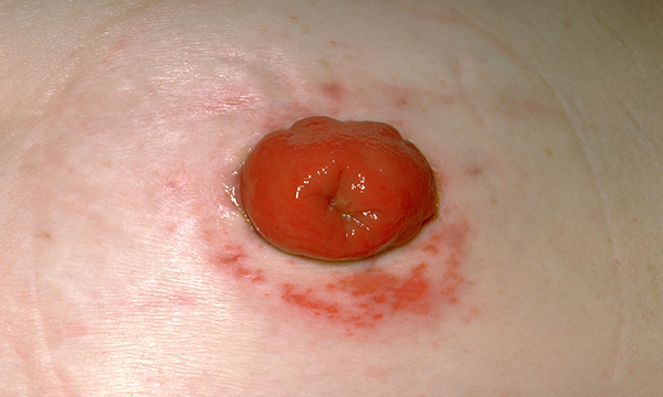 Colostomy stoma