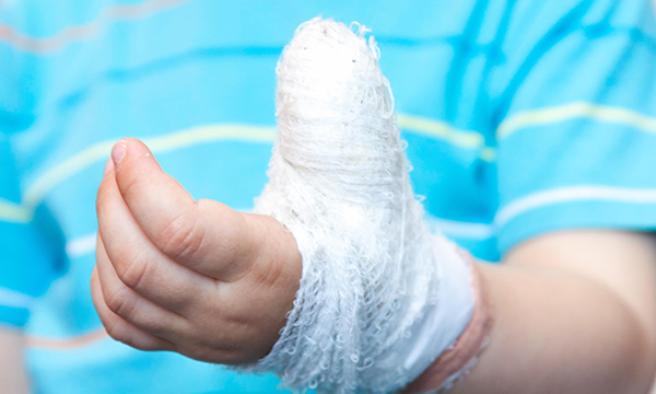 Fingertip injuries in children: a review of the literature
