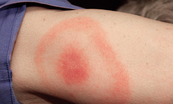 Lyme disease: recognition and management for emergency nurses