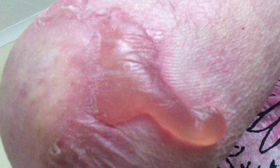 epidermolysis bullos