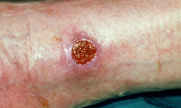 Assessment and management of older people with venous leg ulcers