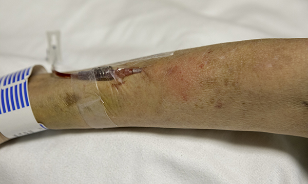 Managing the risk of phlebitis arising from the use of peripheral vascular access devices
