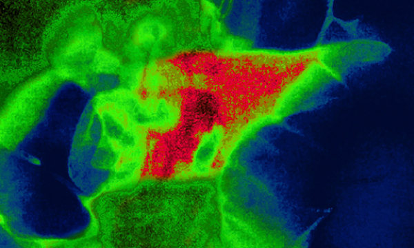 Pathophysiology and nursing management of acute pancreatitis