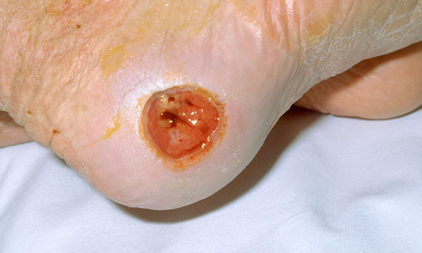 Heel pressure ulcers