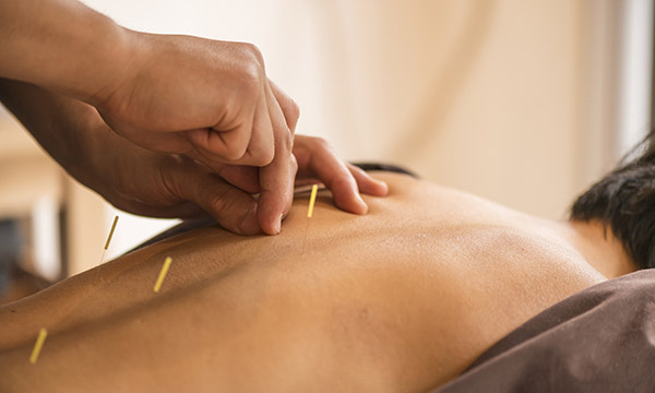 Use of acupuncture in the management of pain