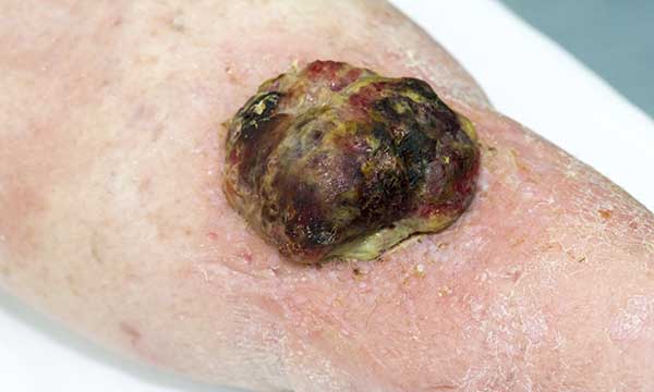 Managing malignant wounds in patients receiving palliative care