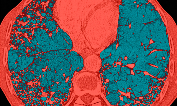 Palliative and end of life care in idiopathic pulmonary fibrosis