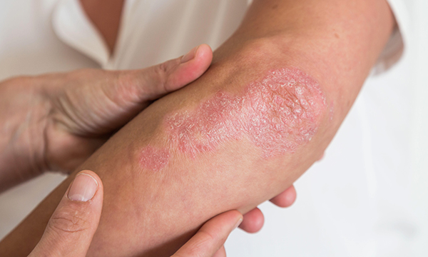 Psoriasis: optimising patients’ quality of life in primary and community care settings