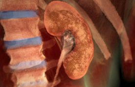 Illustration of a diseased kidney