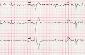 ECG
