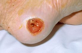 Heel pressure ulcers