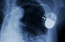 Cardiac pacing: principles, interventions and patient support